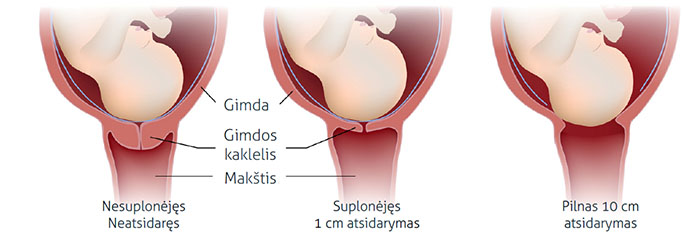 Nėštumo metu gimdos kaklelis užkimštas gleivių kamščiu