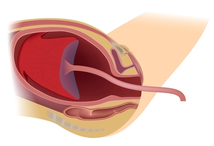 Placentos užgimimo laikotarpis