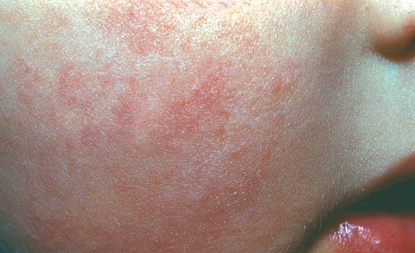 Raudoni mažylio skruostukai jau yra atopinio dermatito ženklas