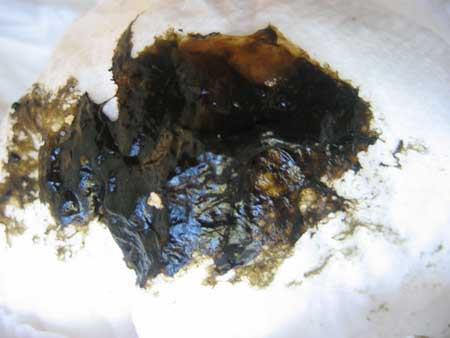 Mekonijus - pirmosios kūdikio išmatos